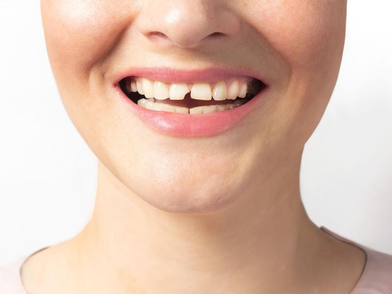 Tratamento para Dente Quebrado em Conjunto Habitacional Padre Anchieta