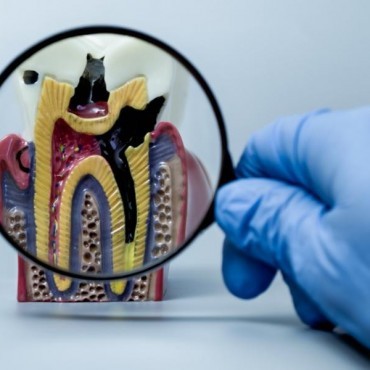 Tratamento para Cárie em Conjunto Habitacional Padre Anchieta