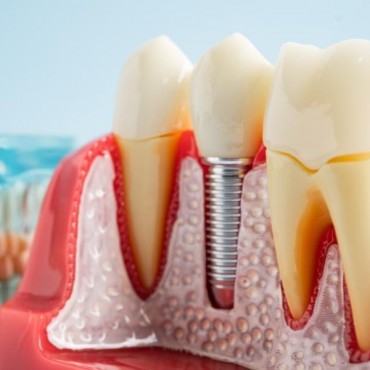 Prótese Dental Fixa em Conjunto Habitacional Padre Anchieta