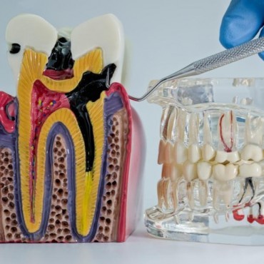 Tratamento Endodôntico em Conjunto Habitacional Padre Anchieta