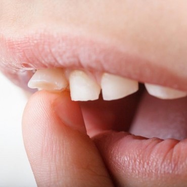 Tratamento para Desgaste dos Dentes em Conjunto Habitacional Padre Anchieta