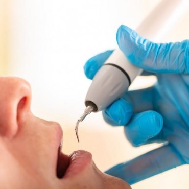 Remoção de Cálculo Dental em Conjunto Habitacional Padre Anchieta