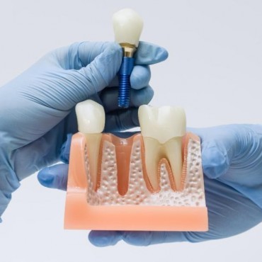 Enxerto Ósseo para Implantes em Conjunto Habitacional Padre Anchieta