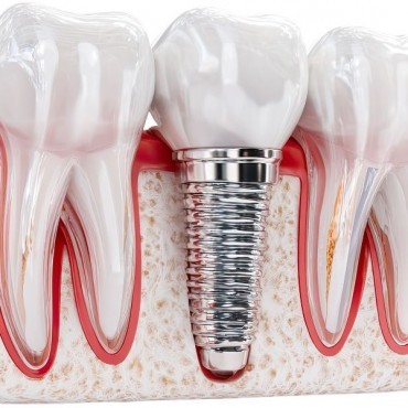 Implante Convencional em Conjunto Habitacional Padre Anchieta