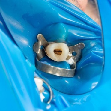 Retratamento de Canal em Conjunto Habitacional Padre Anchieta