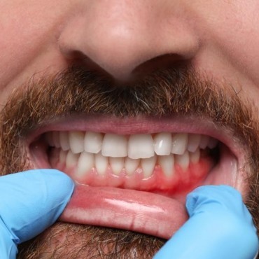 Tratamento para Gengivite em Conjunto Habitacional Padre Anchieta