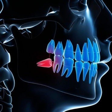 Exodontia de Dentes Inclusos/Dente do Siso em Conjunto Habitacional Padre Anchieta