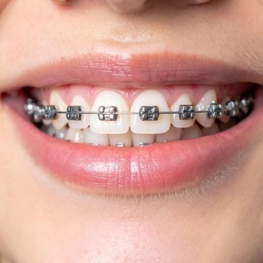 Tratamento Ortodôntico em Conjunto Habitacional Padre Anchieta