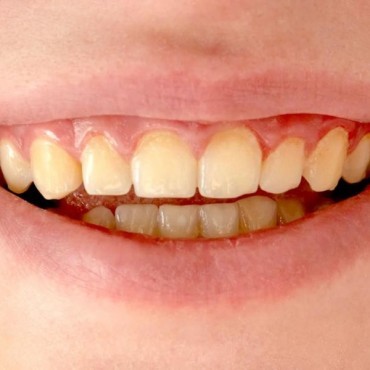 Tratamento para Alteração de Cor do Dente em Conjunto Habitacional Padre Anchieta