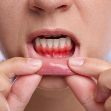 Tratamento para Sangramento na Gengiva em Conjunto Habitacional Padre Anchieta