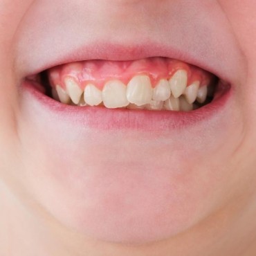 Tratamento para Dentes Tortos em Conjunto Habitacional Padre Anchieta