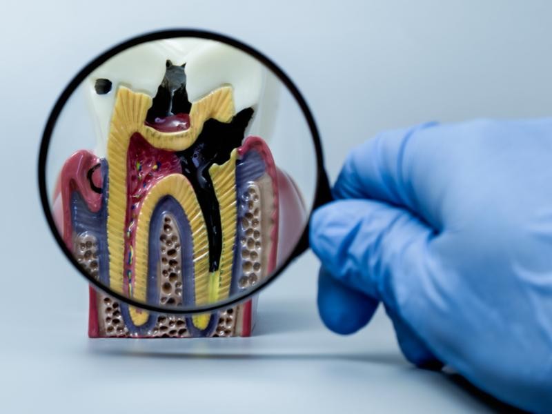 Tratamento para Cárie em Conjunto Habitacional Padre Anchieta