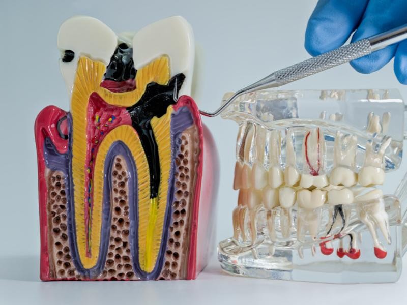 Tratamento Endodôntico