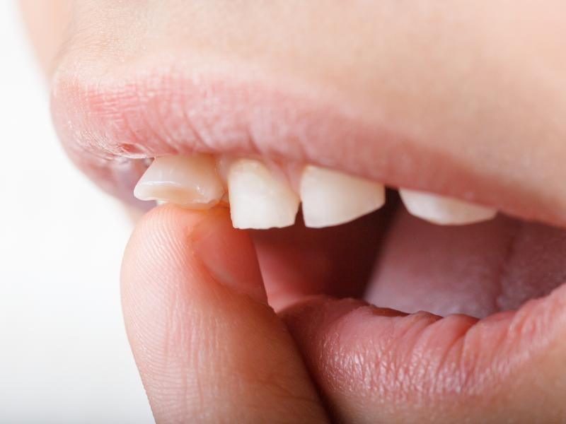Tratamento para Desgaste dos Dentes em Conjunto Habitacional Padre Anchieta