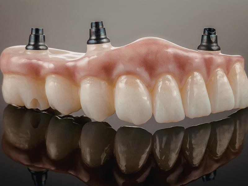 Prótese Fixa Total em Conjunto Habitacional Padre Anchieta