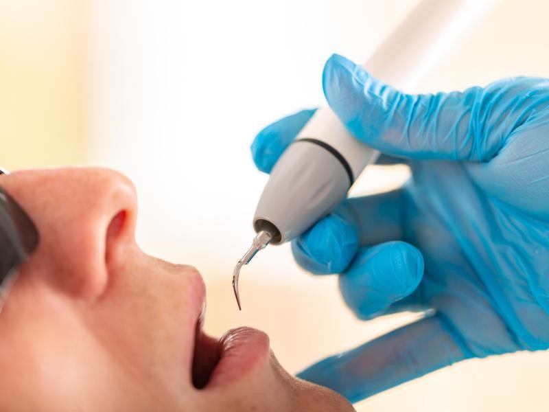 Remoção de Cálculo Dental em Conjunto Habitacional Padre Anchieta