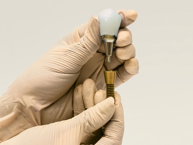 Implantodontia em Conjunto Habitacional Padre Anchieta