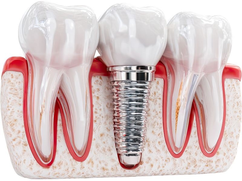 Implante Convencional