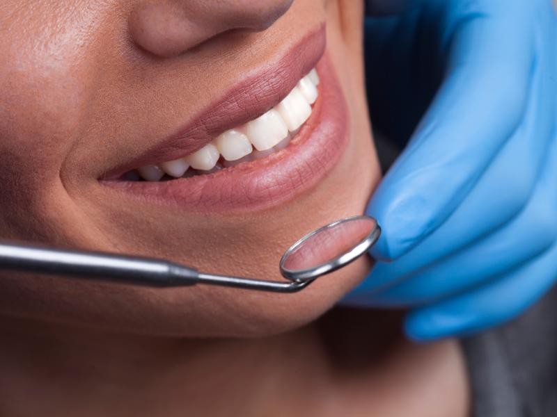 Lentes de Contato Dentais