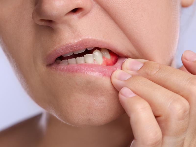 Tratamento Periodontal