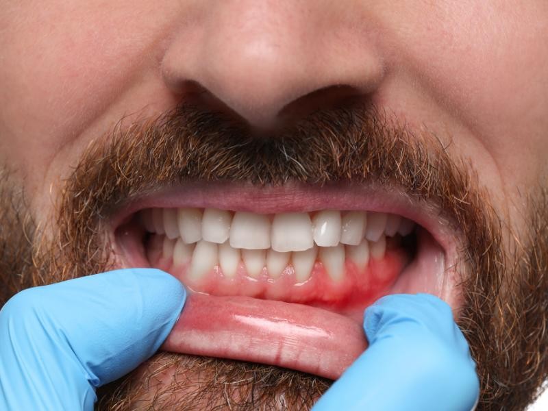 Tratamento para Gengivite