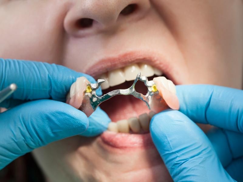 Prótese Dental Removível em Conjunto Habitacional Padre Anchieta