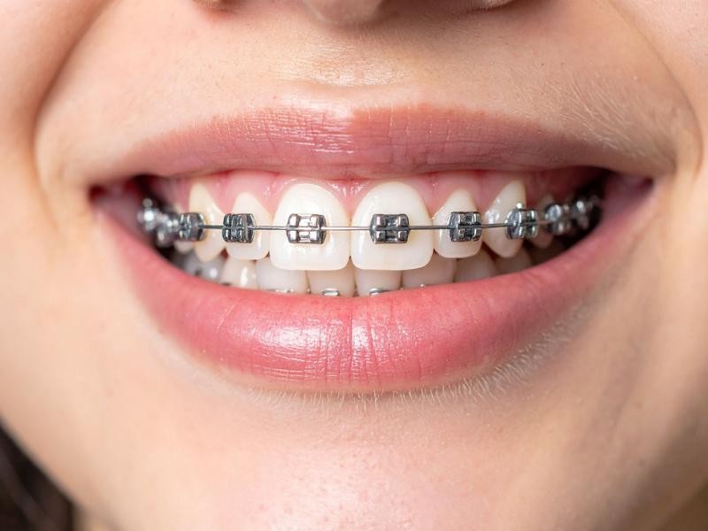 Tratamento Ortodôntico em Conjunto Habitacional Padre Anchieta