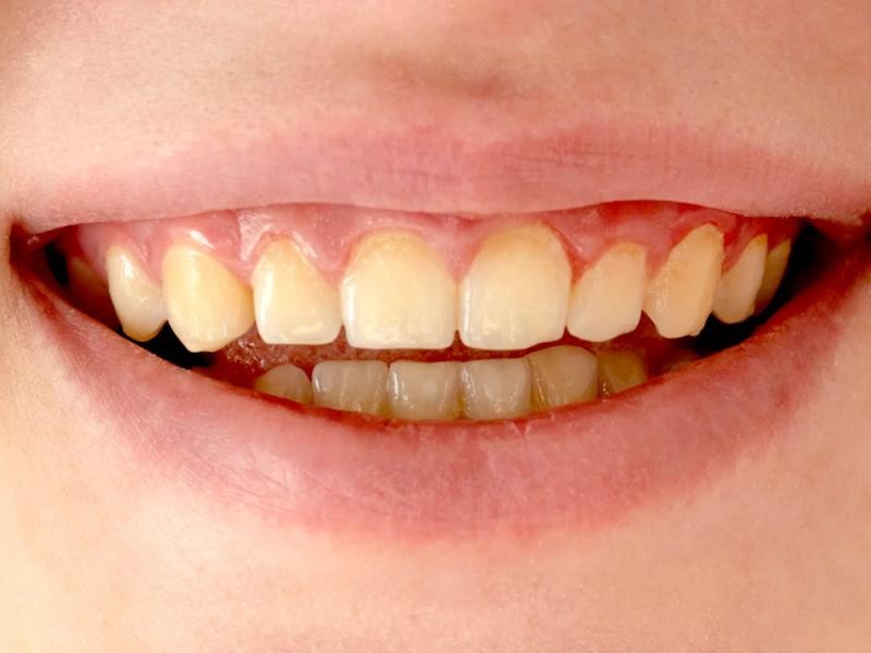 Tratamento para Alteração de Cor do Dente em Conjunto Habitacional Padre Anchieta