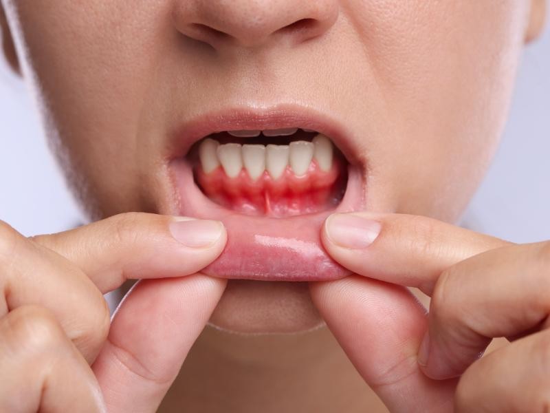 Tratamento para Sangramento na Gengiva em Conjunto Habitacional Padre Anchieta