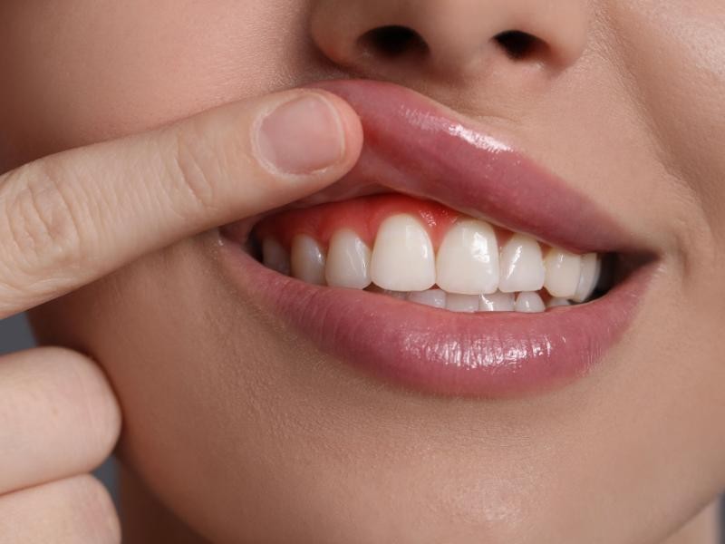 Plástica Gengival em Conjunto Habitacional Padre Anchieta