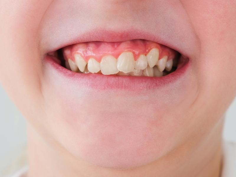 Tratamento para Dentes Tortos em Conjunto Habitacional Padre Anchieta